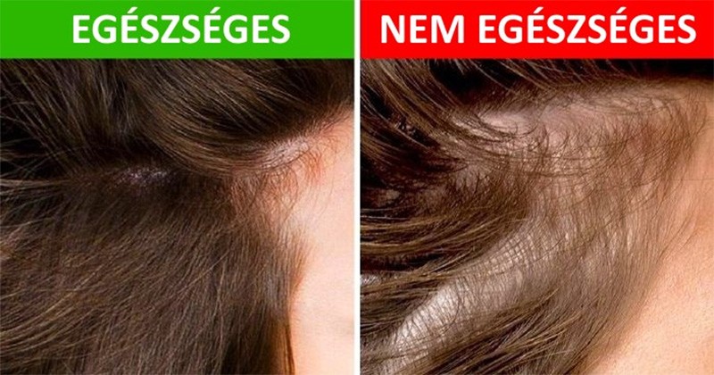 8 dolog, amit a hajad elárulhat az egészségedről
